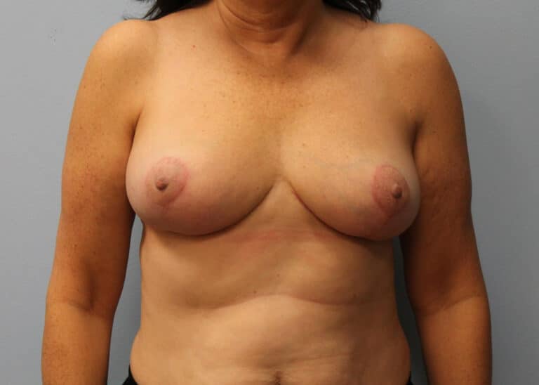 After Image: Breast Reduction – Dr. Howell - front