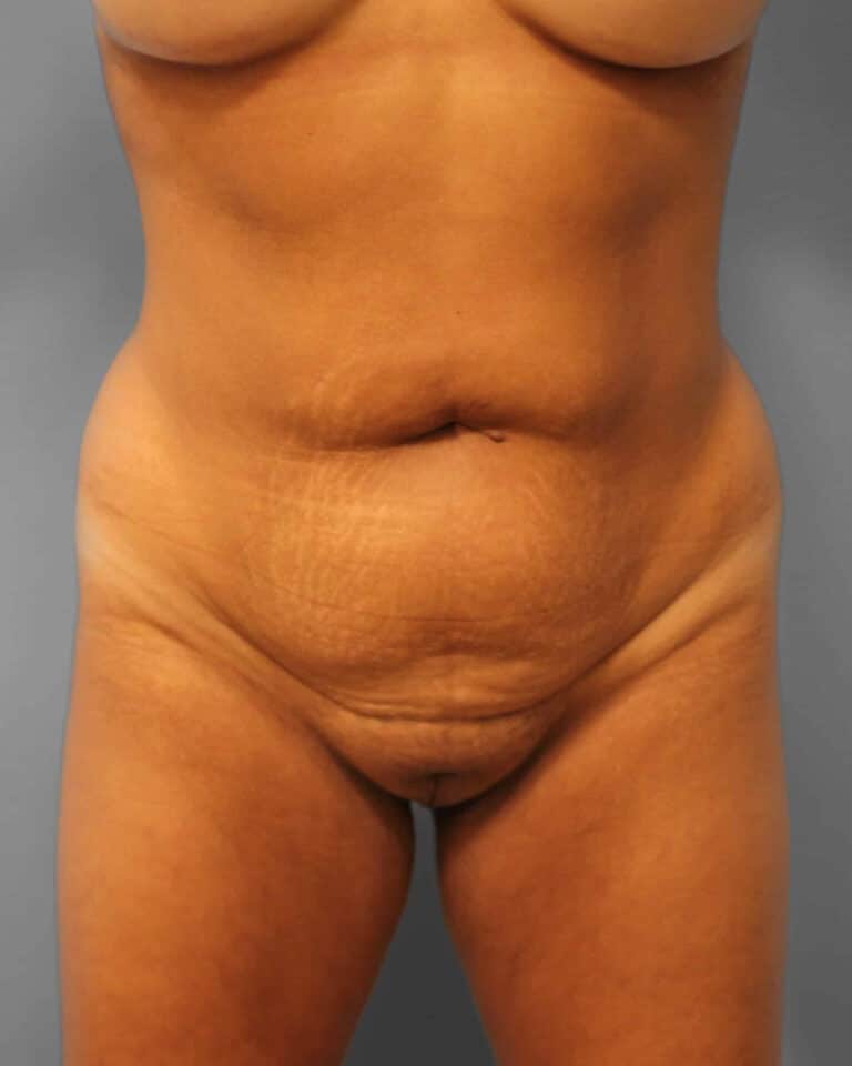 Before Image: Lipo & BBL- Dr. Howell - front