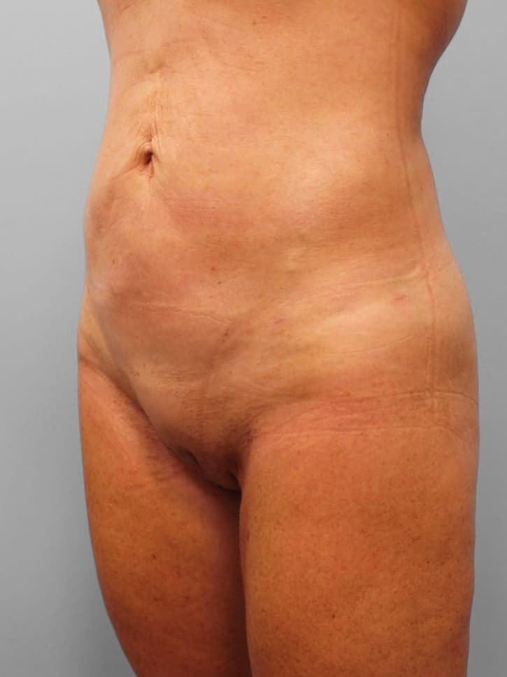 After Image: SmartLipo- Dr. Howell - left-front-oblique