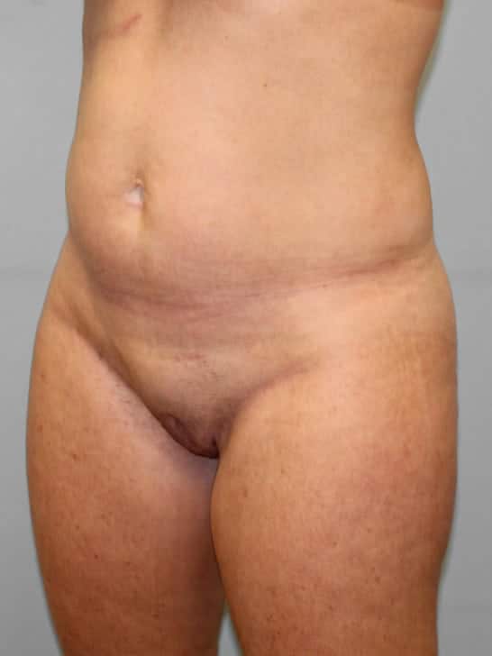 Before Image: SmartLipo- Dr. Howell - left-front-oblique