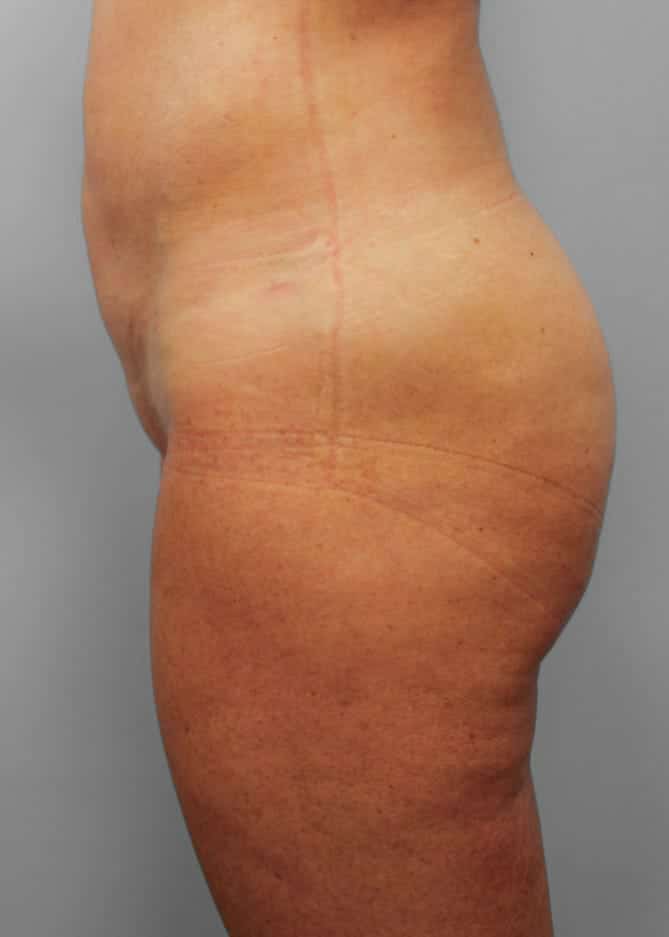 After Image: SmartLipo- Dr. Howell - left-side