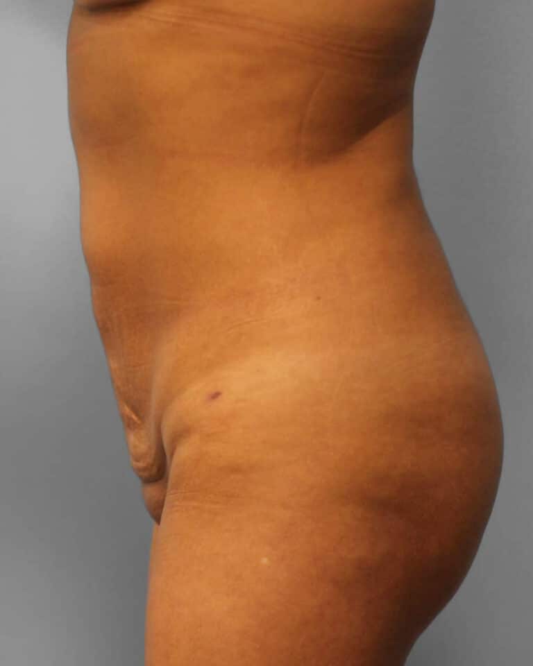 After Image: Lipo & BBL- Dr. Howell - left-side
