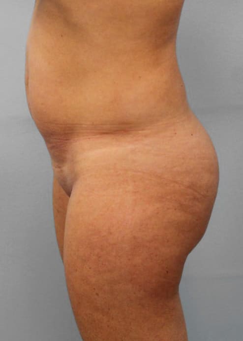Before Image: SmartLipo- Dr. Howell - left-side