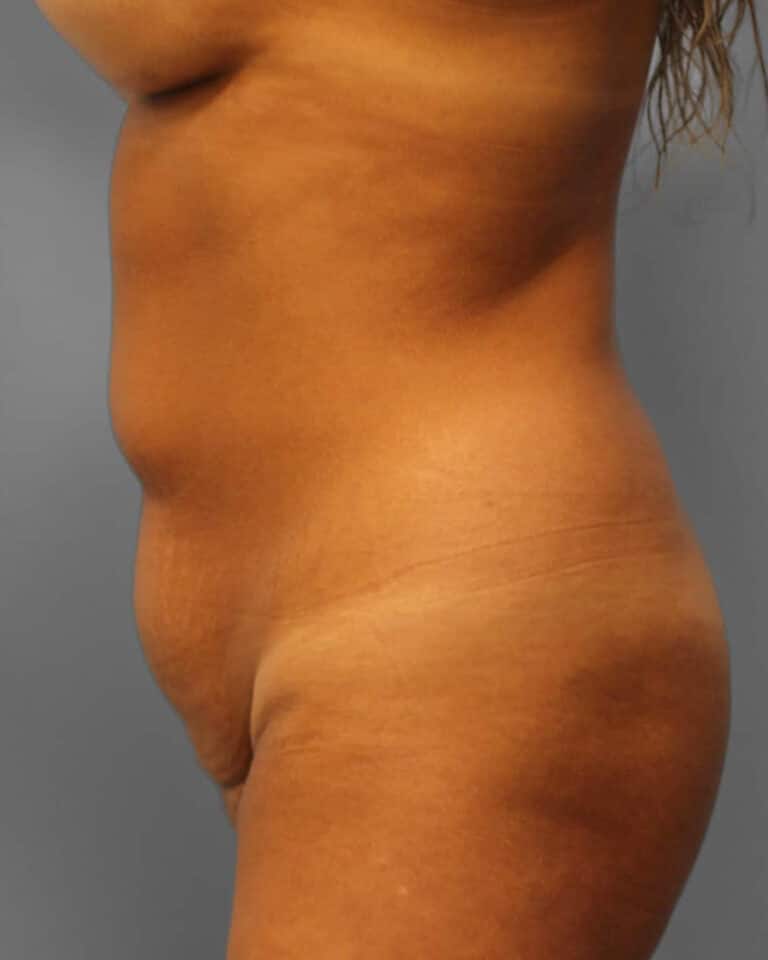 Before Image: Lipo & BBL- Dr. Howell - left-side