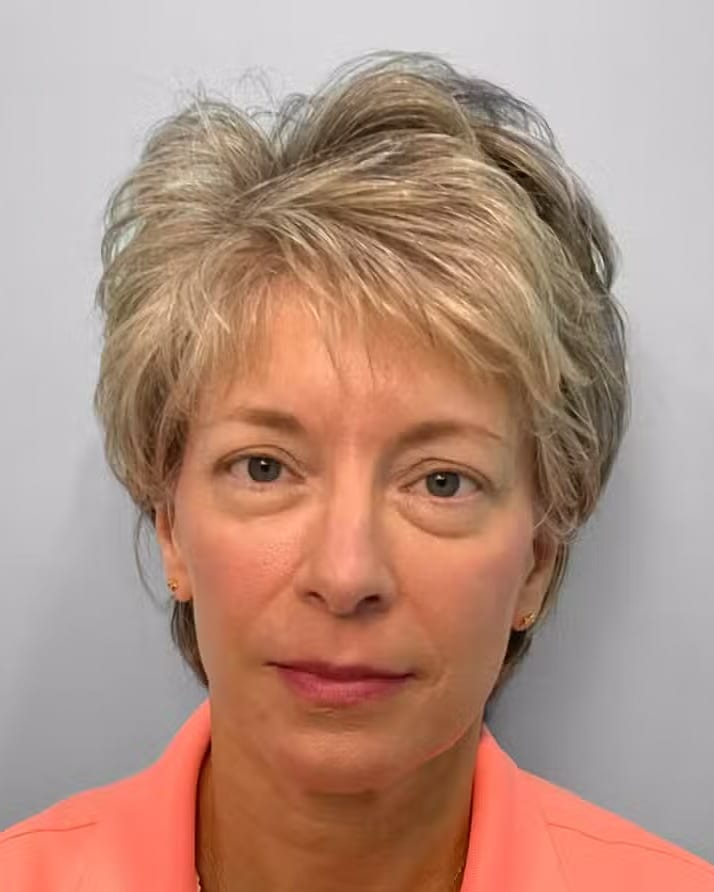 After Image: Juvéderm Voluma – Joy - front