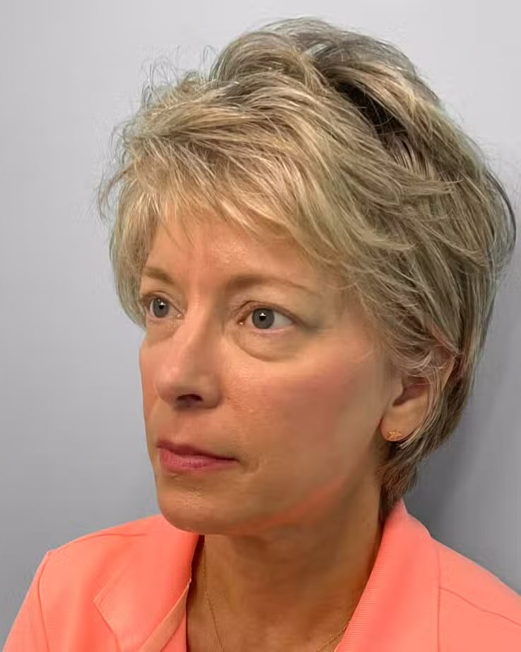 After Image: Juvéderm Voluma – Joy - left-front-oblique