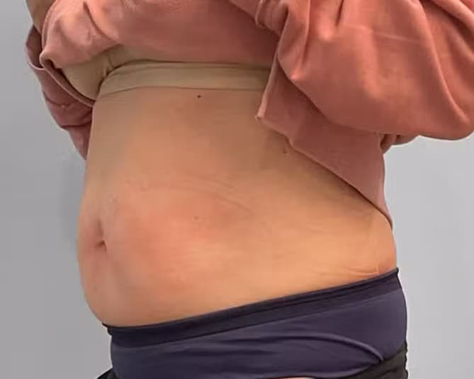 After Image: Emsculpt Neo- Jessica - left-front-oblique