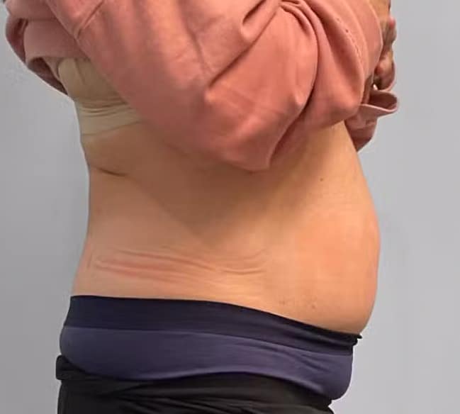 After Image: Emsculpt Neo- Jessica - right-side