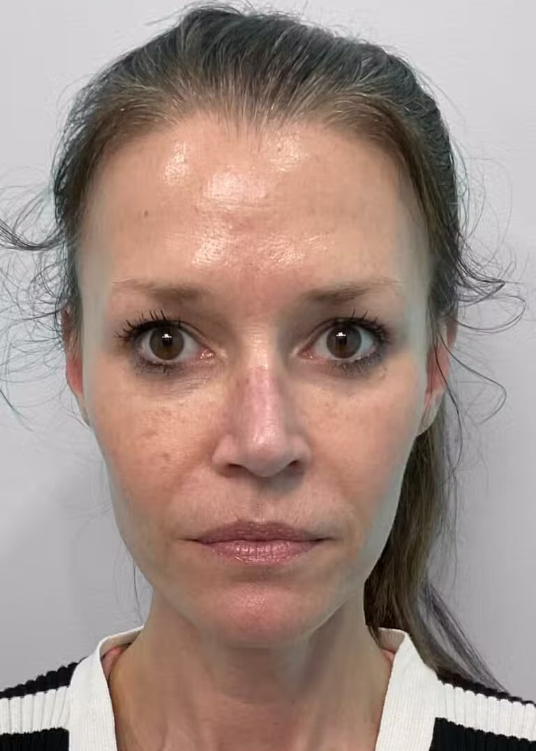 After Image: Juvéderm Vollure & Botox – Joy - front