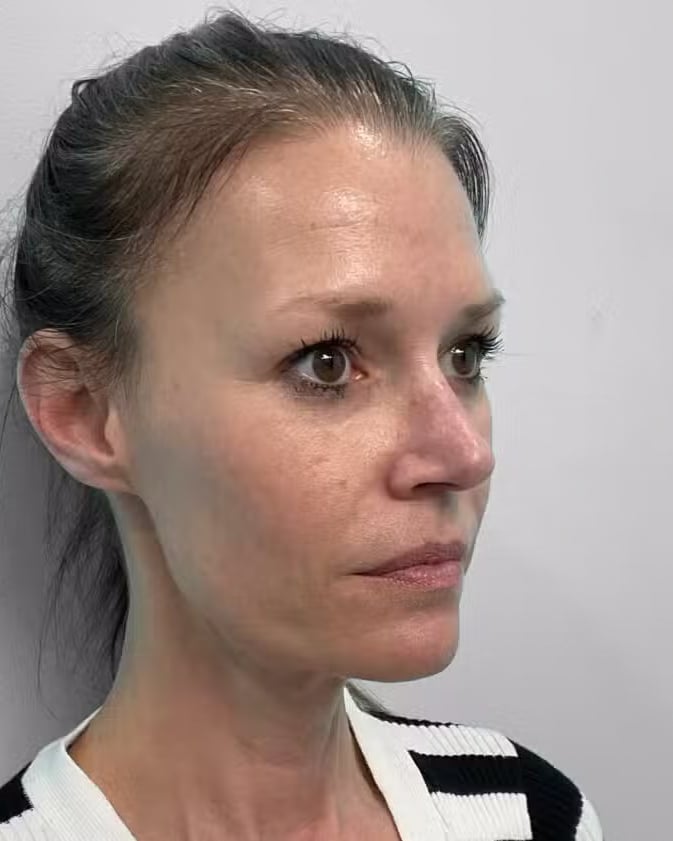 After Image: Juvéderm Vollure & Botox – Joy - right-front-oblique