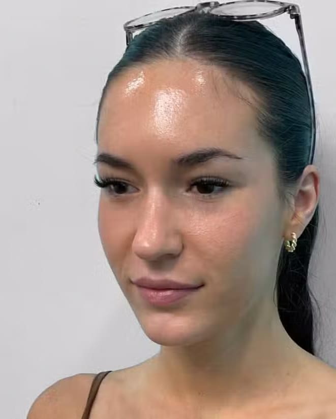 After Image: Juvéderm Vollure – Joy - left-front-oblique