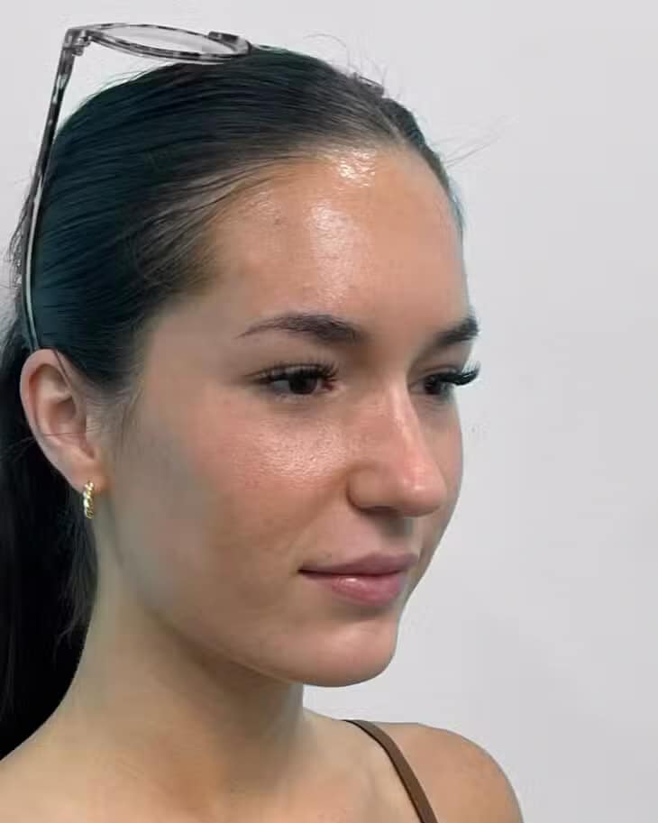 After Image: Juvéderm Vollure – Joy - right-front-oblique