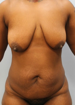 Before Image: Mommy Makeover – Dr. Howell - front