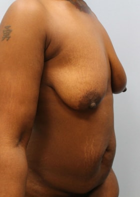 Before Image: Mommy Makeover – Dr. Howell - other
