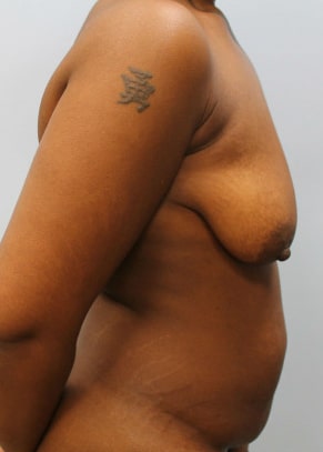 Before Image: Mommy Makeover – Dr. Howell - other