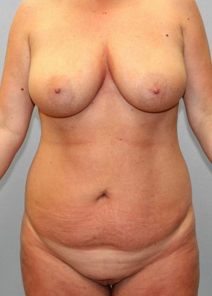 Before Image: Mommy Makeover & Mastopexy – Dr. Howell - front