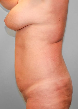 Before Image: Mommy Makeover & Mastopexy – Dr. Howell - left-side