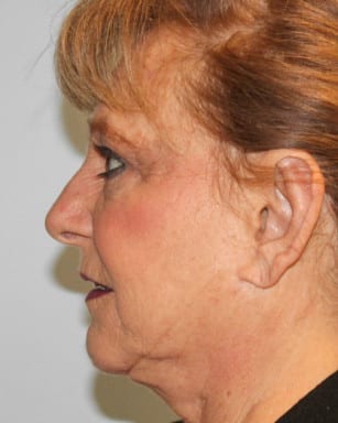 After Image: Otoplasty – Dr. Tucker - left-side