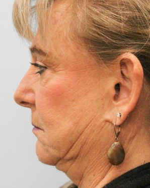 Before Image: Otoplasty – Dr. Tucker - left-side