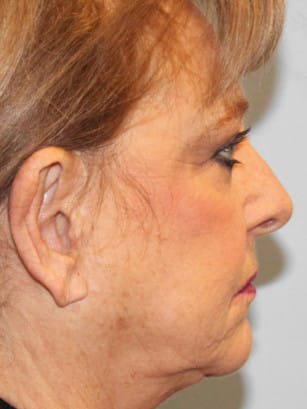 After Image: Otoplasty – Dr. Tucker - right-side