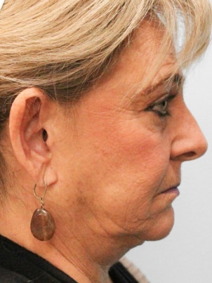 Before Image: Otoplasty – Dr. Tucker - right-side