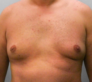 Before Image: Gynecomastia – Dr. Tucker - front