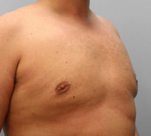 After Image: Gynecomastia – Dr. Tucker - right-front-oblique