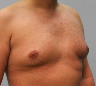 Before Image: Gynecomastia – Dr. Tucker - right-front-oblique