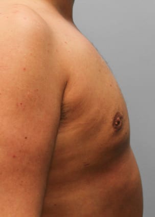 After Image: Gynecomastia – Dr. Tucker - right-side