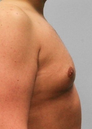 Before Image: Gynecomastia – Dr. Tucker - right-side
