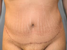 After Image: Abdominoplasty & Flank Lipo – Dr. Tucker - front