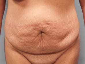 Before Image: Abdominoplasty & Flank Lipo – Dr. Tucker - front