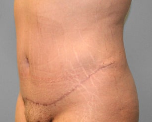 After Image: Abdominoplasty & Flank Lipo – Dr. Tucker - left-front-oblique
