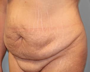 Before Image: Abdominoplasty & Flank Lipo – Dr. Tucker - left-front-oblique