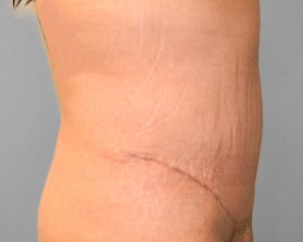 After Image: Abdominoplasty & Flank Lipo – Dr. Tucker - right-side