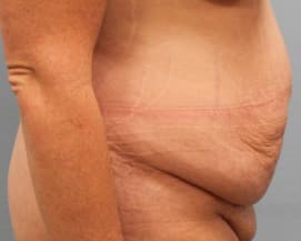 Before Image: Abdominoplasty & Flank Lipo – Dr. Tucker - right-side