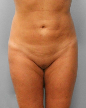 After Image: Smart Lipo – Dr. Tucker - front