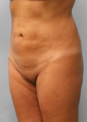 After Image: Smart Lipo – Dr. Tucker - left-front-oblique