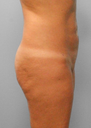 After Image: Smart Lipo – Dr. Tucker - right-side
