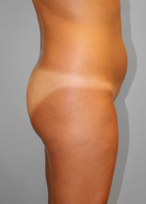 Before Image: Smart Lipo – Dr. Tucker - right-side