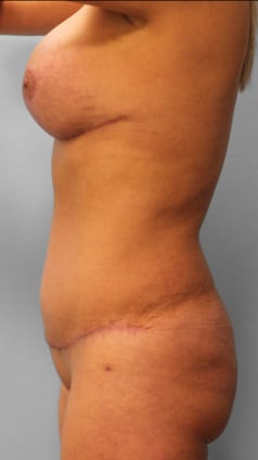 After Image: Mommy Makeover – Dr. Howell - other