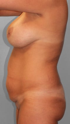 Before Image: Mommy Makeover – Dr. Howell - other