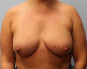 After Image: Breast Augmentation – Dr. Tucker - front