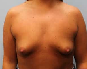 Before Image: Breast Augmentation – Dr. Tucker - front