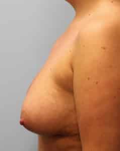 After Image: Breast Augmentation – Dr. Tucker - left-side
