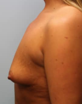 Before Image: Breast Augmentation – Dr. Tucker - left-side