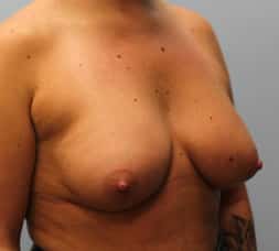 After Image: Breast Augmentation – Dr. Tucker - right-front-oblique