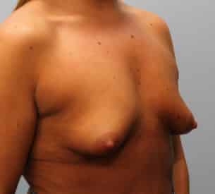 Before Image: Breast Augmentation – Dr. Tucker - right-front-oblique
