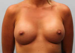 After Image: Breast Augmentation – Dr. Howell - front