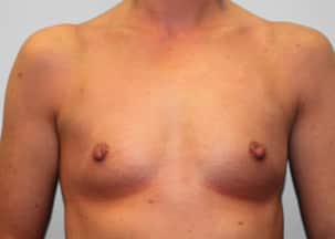 Before Image: Breast Augmentation – Dr. Howell - front